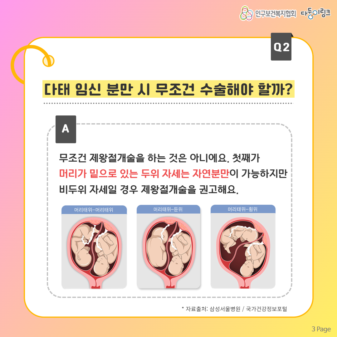 다태임신 분만 시 무조건 수술해야 할까