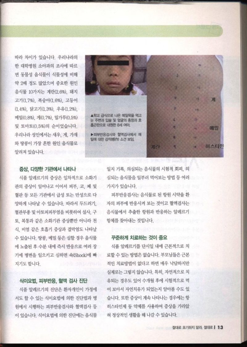 따라 차이가 있습니다. 우리나라의 한 대학병원 소아과의 조사에 따르 면 동물성 음식물이 식물성에 비해 약 2배 정도 많았으며 중요한 원인 음식물 10가지는 계란2.6 돼지 고기1.7 복숭아1.6 고등어 1.4 닭고기1.3 우유1.2 메밀0.8 게0.7 밀가루0.5 및 토마토0.5의 순이었습니다. 우리나라 성인에서는 새우 게 가재 와 땅콩이 가장 흔한 원인 음식물로 알려져 있습니다. 증상 다양한 기관에서 나타나 ▲학교 급식으로 나온 메밀묵을 먹고 눈 주변과 입술 및 얼굴의 종창과 호 흡곤란으로 내원한 8세 여아 ▶피부반응검사와 혈액검사에서 메 밀에 대한 감작 소견 보임 예란 식품 알레르기의 증상은 일차적으로 소화기 관의 증상이 일어나고 이어서 피부 코 폐 및 혈관 등 모든 기관에서 급성 또는 만성으로 다 양하게 나타날 수 있습니다. 따라서 두드러기 혈관부종 및 아토피피부염을 비롯하여 설사 구 토 복통과 같은 소화기관 증상뿐만 아니라 천 식 비염 같은 호흡기 증상과 결막염도 나타날 수 있습니다. 땅콩 메밀 등은 심할 경우 음식물 에 노출된 후 수분 내에 즉시 반응으로 여러 장 기에 병변을 일으키고 심하면 속Shock에 빠 지기도 합니다. 식이요법 피부반응 혈액 검사 진단 식품 알레르기의 진단은 환자개인이 가정에 서도 할 수 있는 식이요법에 의한 진단법과 병 원에서 시행하는 피부반응검사와 혈액검사 등 이 있습니다. 식이요법에 의한 진단에는 음식물 일지 기록 의심되는 음식물의 시험적 회피 의 심되는 음식물을 일부러 먹어보는 방법 등 여러 가지가 있습니다. 피부반응검사는 음식물로 된 항원 시약을 환 자의 피부에 반응시켜 보는 것이고 혈액검사는 음식물에서 추출한 항원과 반응하는 알레르기 항체를 찾아내는 것입니다. 꾸준하게 치료하는 것이 중요 식품 알레르기를 단시일 내에 근본적으로 치 료할 수 있는 방법은 없습니다. 부모님들은 근본 적인 치료방법이 없다고 하면 매우 낙담하지만 실제로는 그렇지 않습니다. 특히 자연적으로 치 유되는 경우도 있어 수개월 후에 시험적으로 먹 어 보아서 자연치유가 되었는지 알아볼 수도 있 습니다. 또한 증상이 계속 나타나는 경우에는 항 히스타민제 등 약제를 사용하여 증상을 가라앉 혀 정상적인 생활을 해 나갈 수 있습니다.